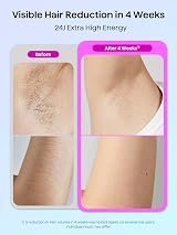 Wavytalk IPL Hair Removal Device, Painless Ice Cooling, 24J Energy view 2