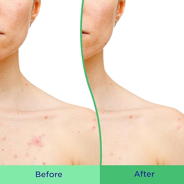 DIFFERIN BODY SCRUB WITH SALICYLIC ACID ACNE CLEARING IMPROVES TONE AND TEXTURE PRONE SKIN ON BACK SHOULDERS AND CHEST, 8 OZ (PACKAGING MAY VARY)