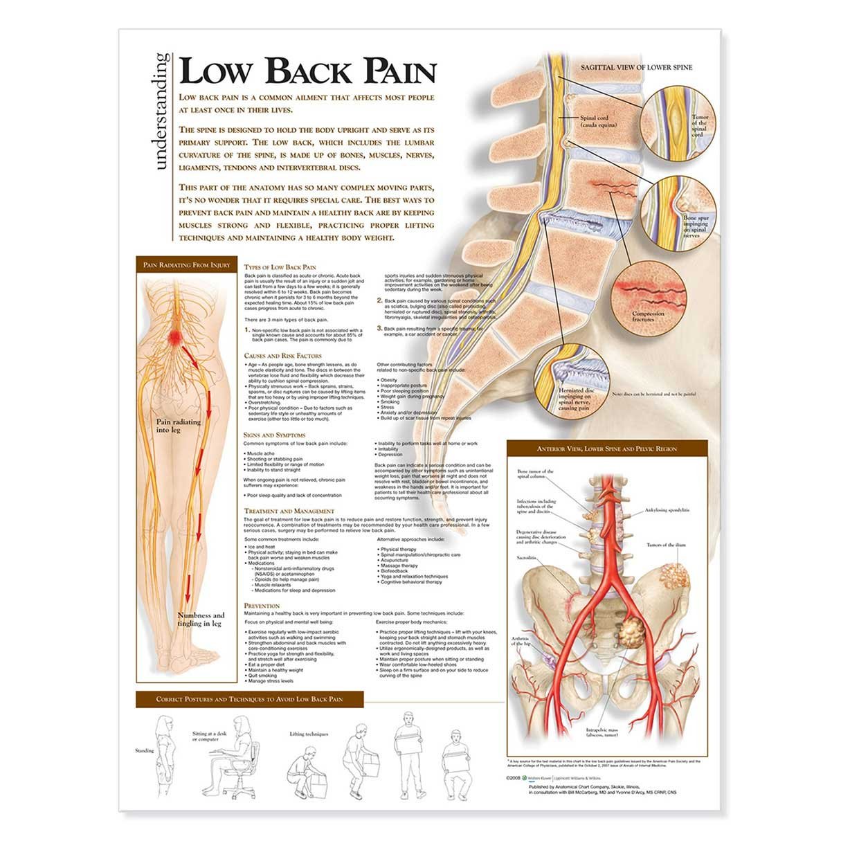 Understanding Low Back Pain Anatomical Chart