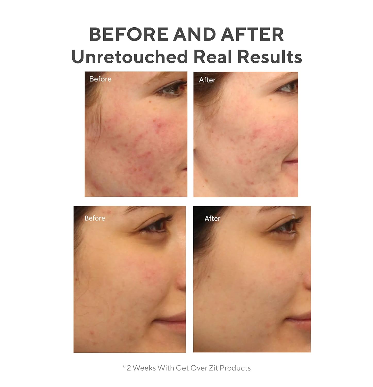 Murad Get Over Zit Kit - Breakout Skin Care Kit with Face Clarifying Cleanser, Breakout Skin Treatment and SPF Facial Mattifier - 3 Trial Size Skin Care Products for Blemish and Breakout Prone Skin: Premium Beauty