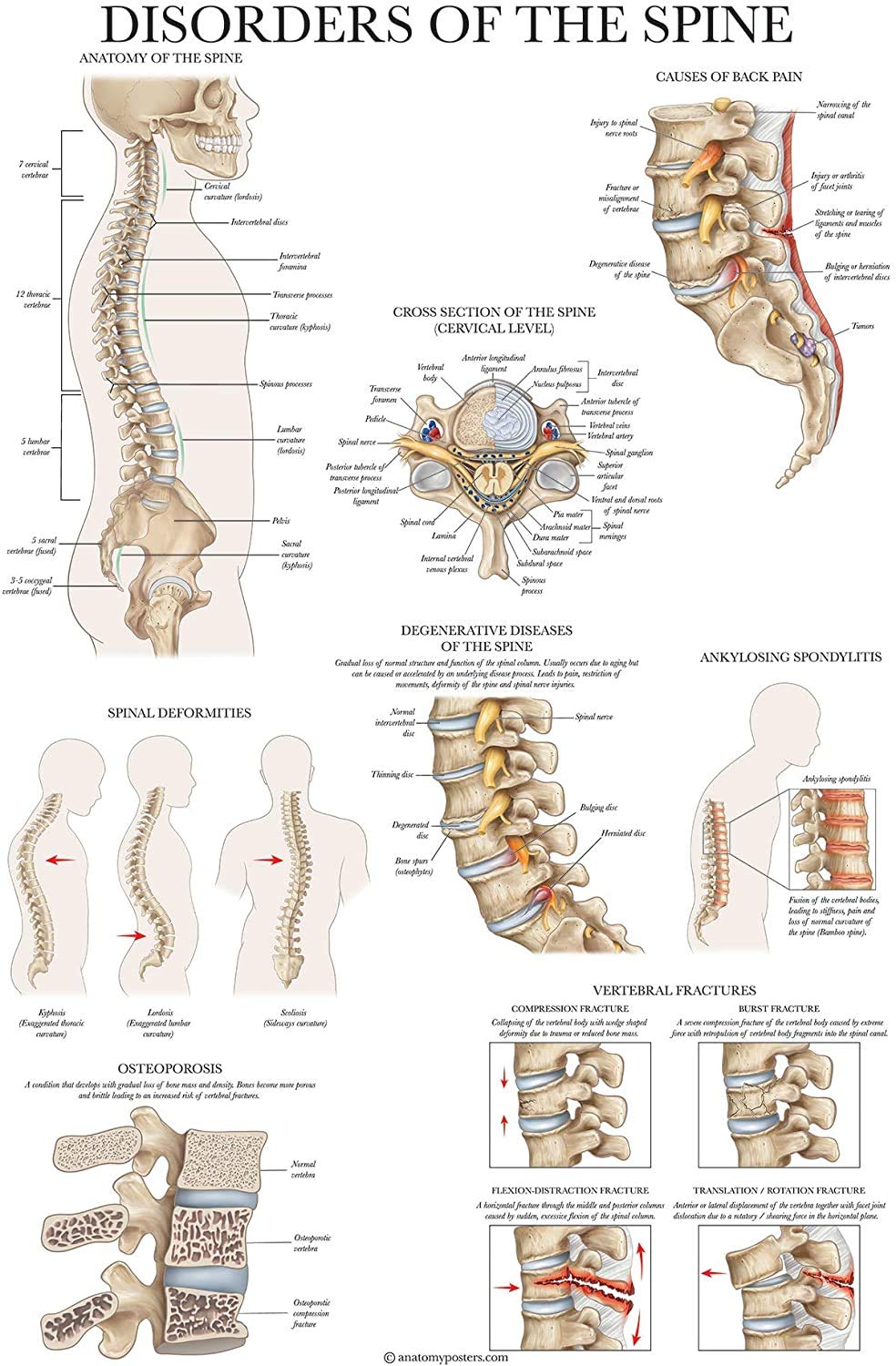 Palace Learning Disorders of the Spine Anatomy Poster - Laminated Spinal Disorders Anatomical Chart - 18" x 24"