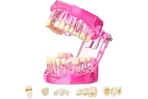 Outus Disease Teeth Model Dental Implant Teeth Model with Removable Tooth Dentist Standard Tooth Pathological Demonstration for Christmas Education Dental Supplies(Pink,1 Pcs)