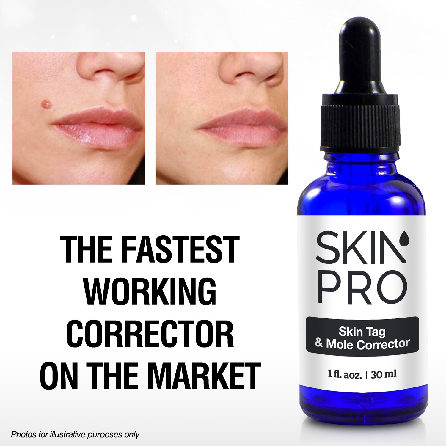 SkinPro Skin Tag Remover And Mole Corrector For Fast Removal Of Skin Moles, Skin Tags, Warts And Other Minor Growths, Medical Grade Formula with 17% Salicylic Acid (1 fl oz, 30 ml) : Beauty
