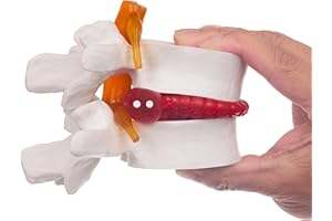 Ruiishunyy Human Anatomical Lumbar Disc Herniation Model, 1.5 Times Life Size Lumbar Vertebrae Disc Herniation Model, Portable Lumbar Spine Model for Medical, Teaching and Demonstrating