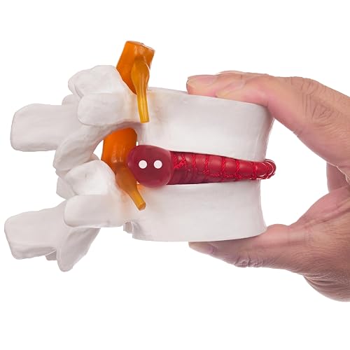 Disc Model Back Human Anatomical Lumbar Disc Herniation Model, 1.5 Times Life Size ...