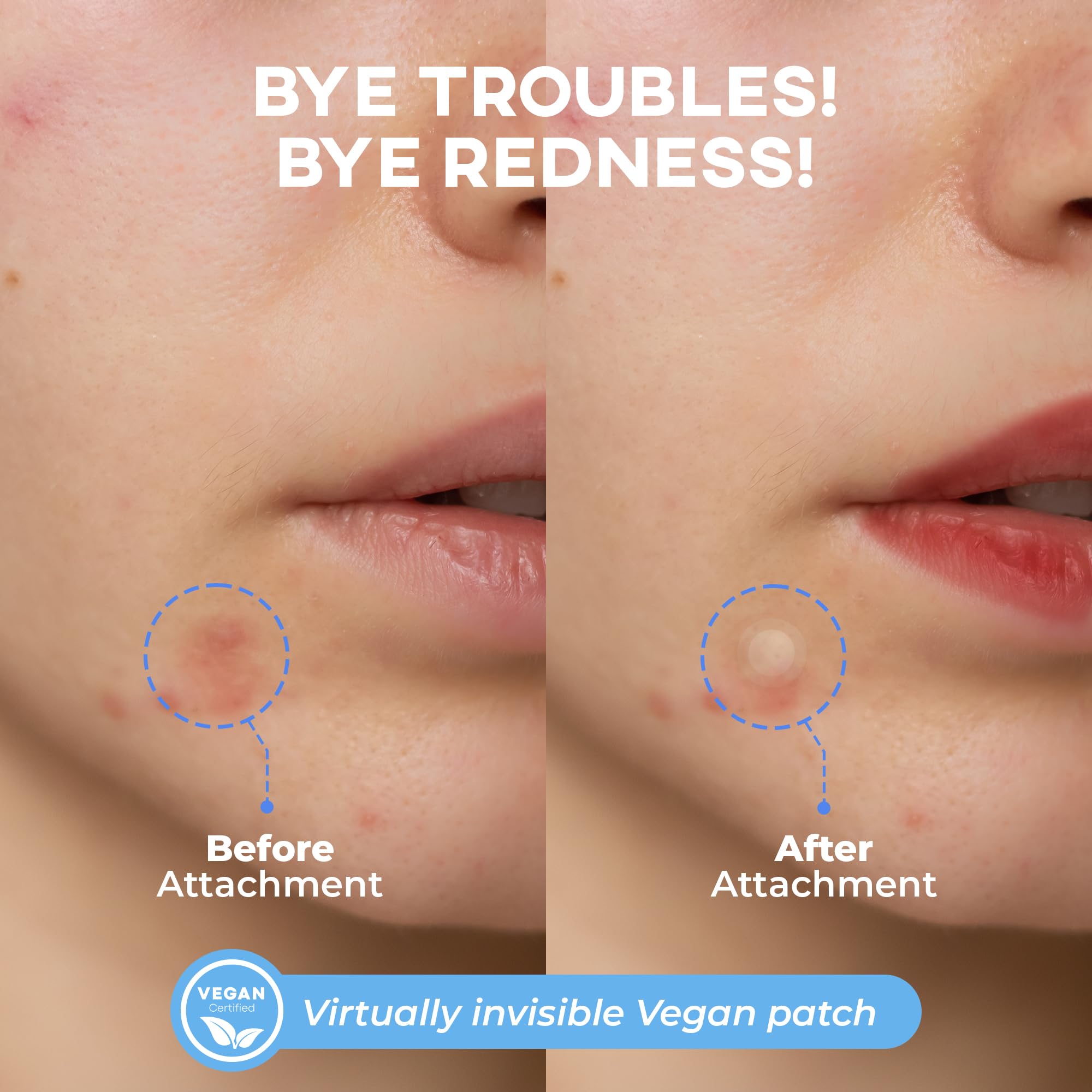 NOLAHOUR Hydrocolloid Patch STEP2 | Invisible Ultra-Thin Bandages | Vegan Patch for Pimple-Prone Skin | Korean Skin Care Face Pimple Patches (Pack of 1, 63 Patches)