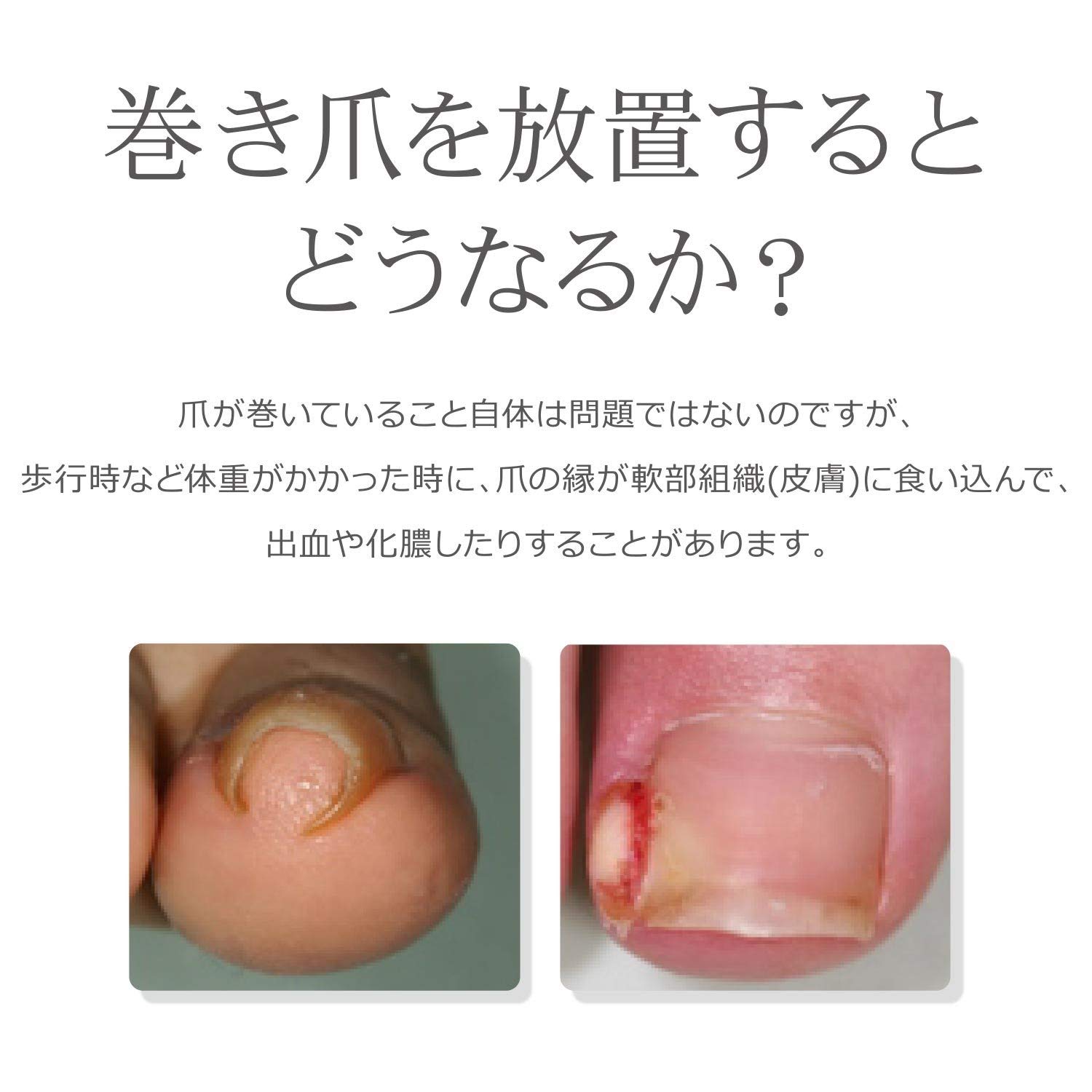 巻き爪用クリップ S Dr Scholl 特典テープ付 ドクターショール 巻き爪用クリップ S Dr Scholl 特典テープ付 ドクターショール