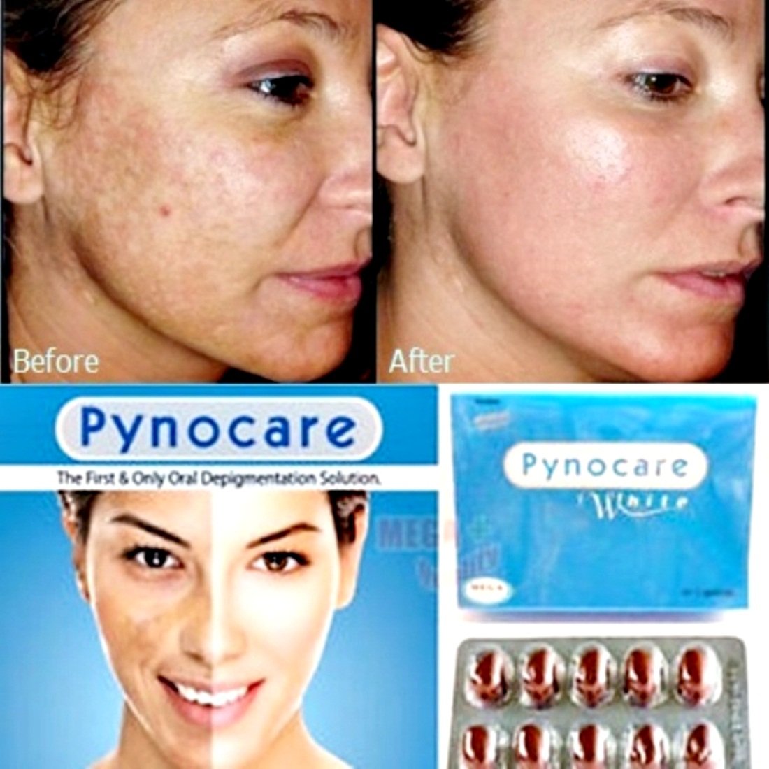20 PACK(400 CAPSULES) OF PYNOCARE 100 HERBAL WHITENIN ANTI MELASMA
