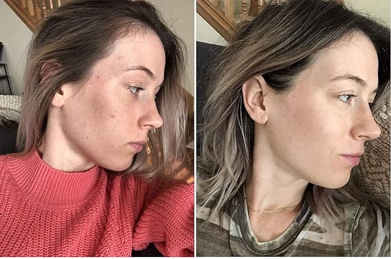 dr dennis universal peel