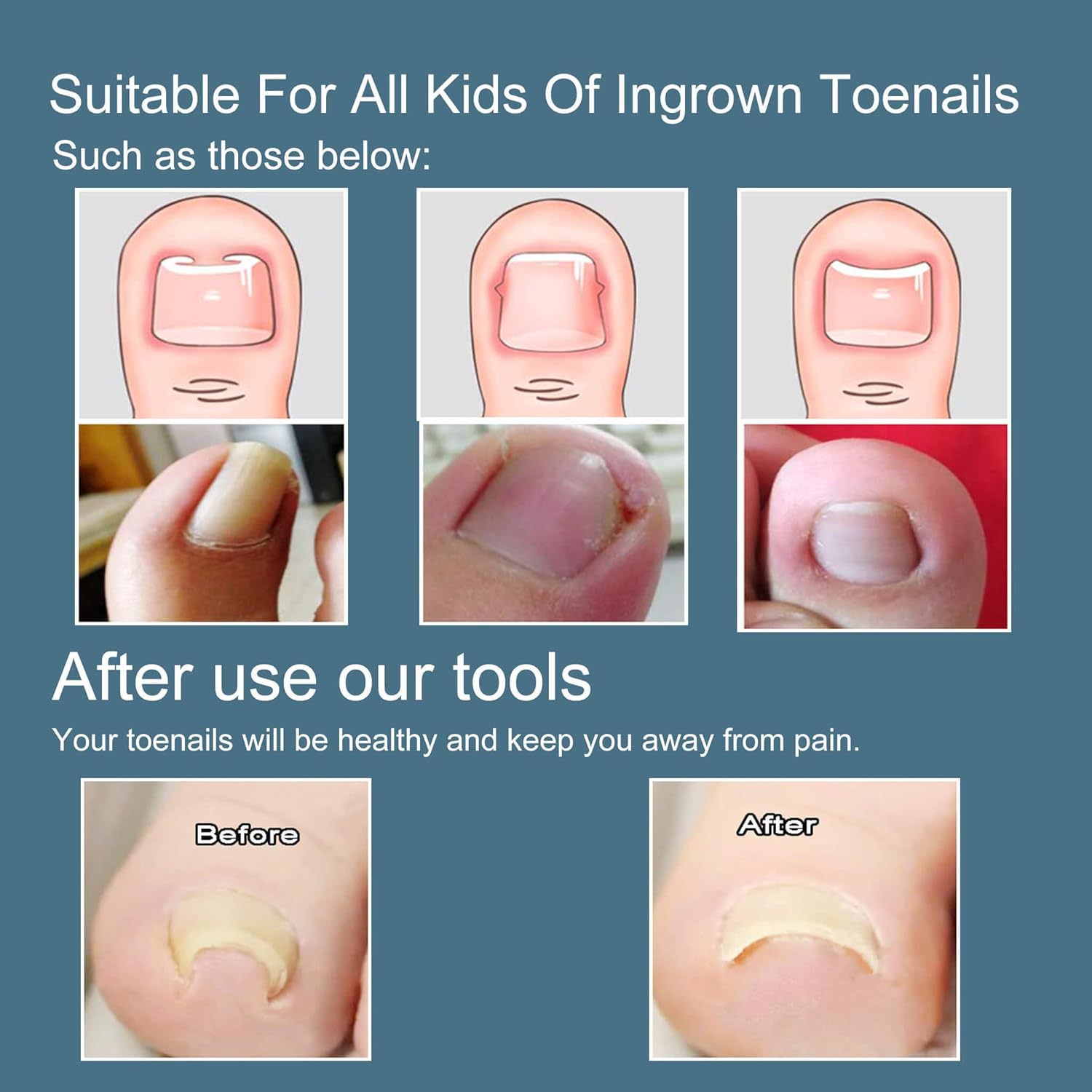 Ingrown Toenail Tool, 47 Pieces Ingrown Toenail Corrector and Lifter Toe Nail Correction Buckle Kit With Sticker for Professional Treatment (M): Beauty