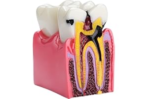 Healthible Dental Caries Tooth Model - 6 Times Tooth Decay Model Dental Models for Patient Education Root Canal Model Tooth Model for Teaching Kids