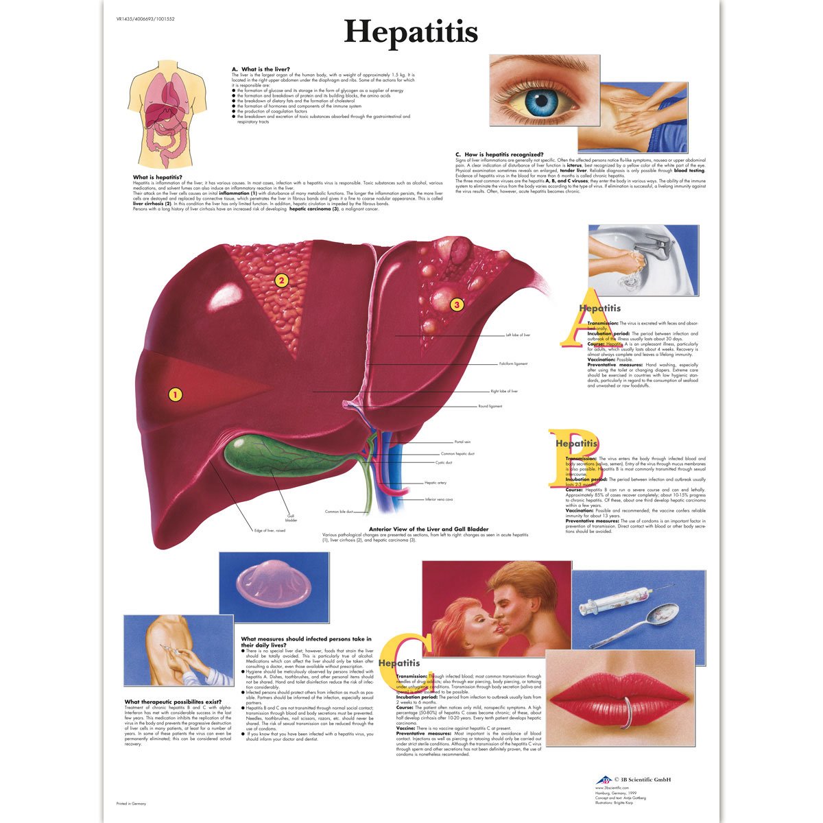 3B Scientific Human Anatomy - Hepatitis Chart, Laminated Version