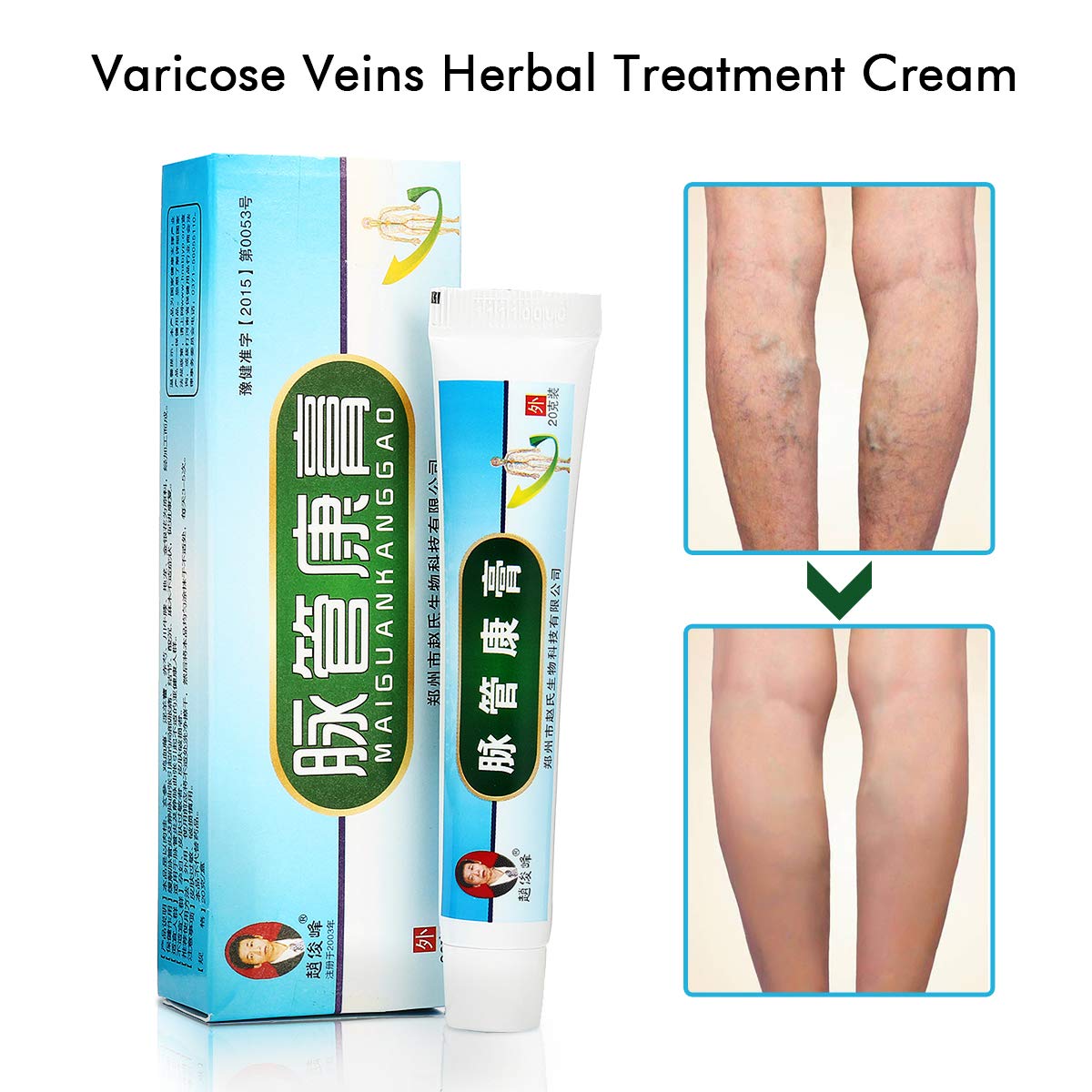 Herbal Varicose Vein Treatment Luckyfine Anti Foot Leg Vasculitis Pain Relief Vein Cream For Spider Veins