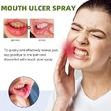 HIVETZ Mouth Ulcer Treatment Spray Herbal Breath Freshener Adults view 4