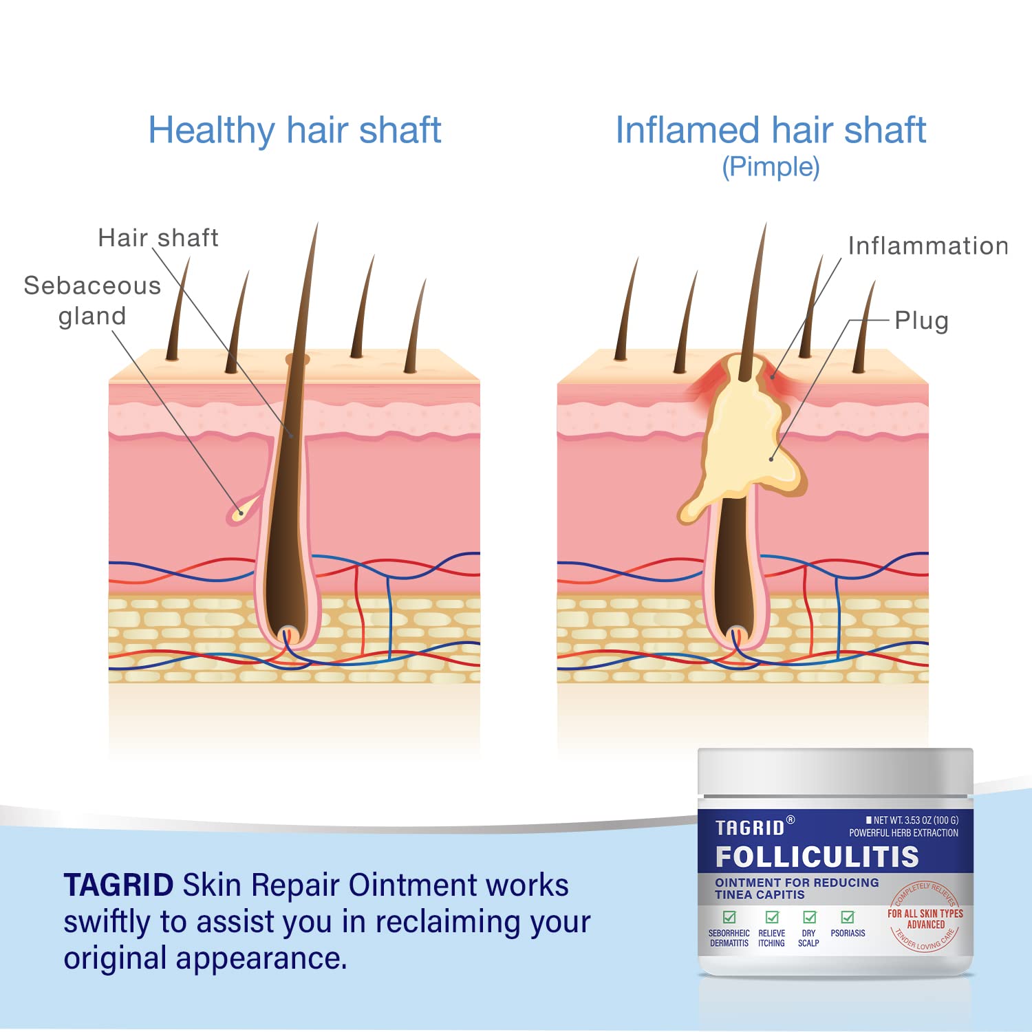 mua-folliculitis-folliculitis-treatment-severe-folliculitis-treatment