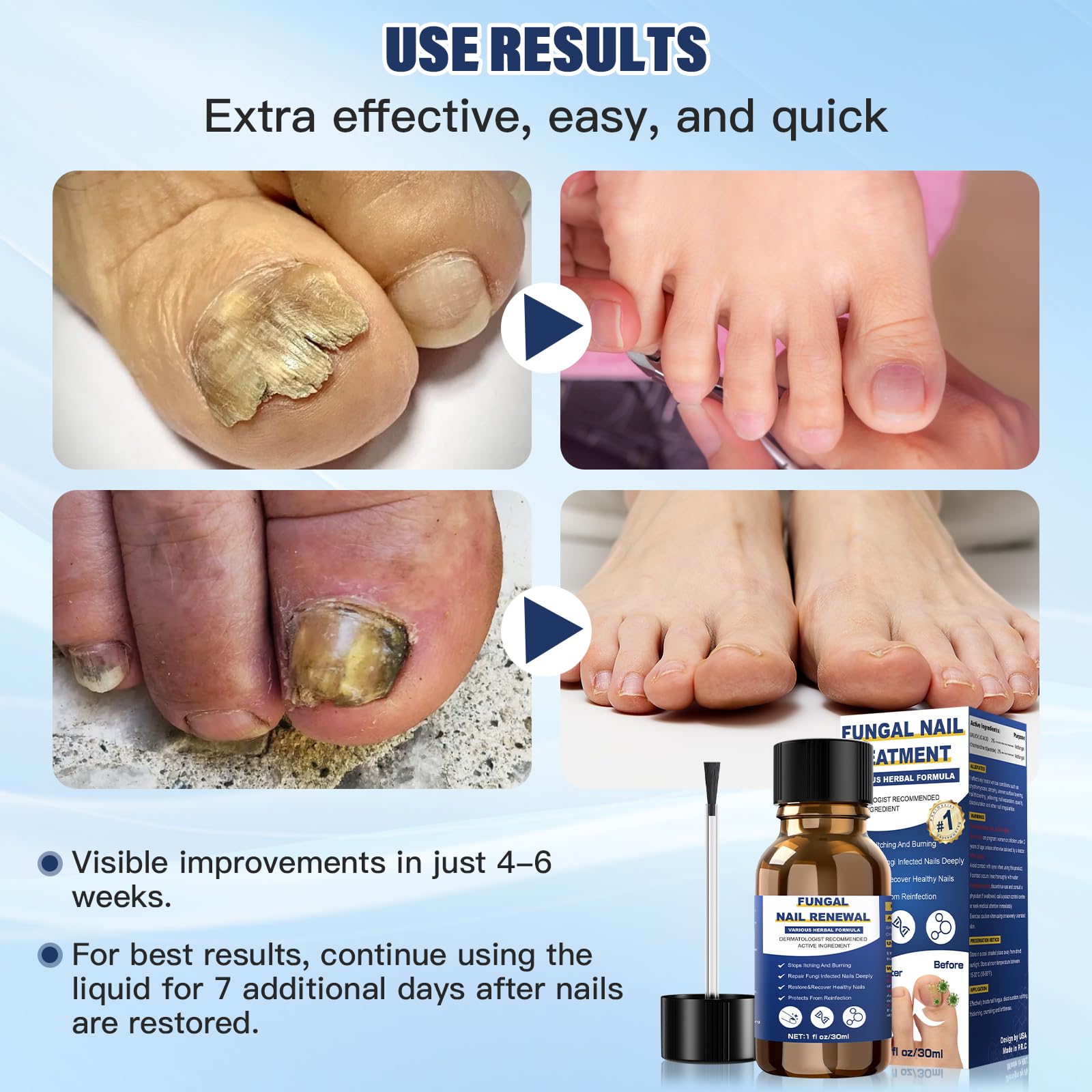 Toenail Fungus Treatment Extra Strength,Nail Fungus Treatment For Toenail,Athletes Foot Treatment,Ingrown Toenail Treatment,Toe Nail Fungus Treatments For Fungi Nail(1fl oz/30ml) - Image 6