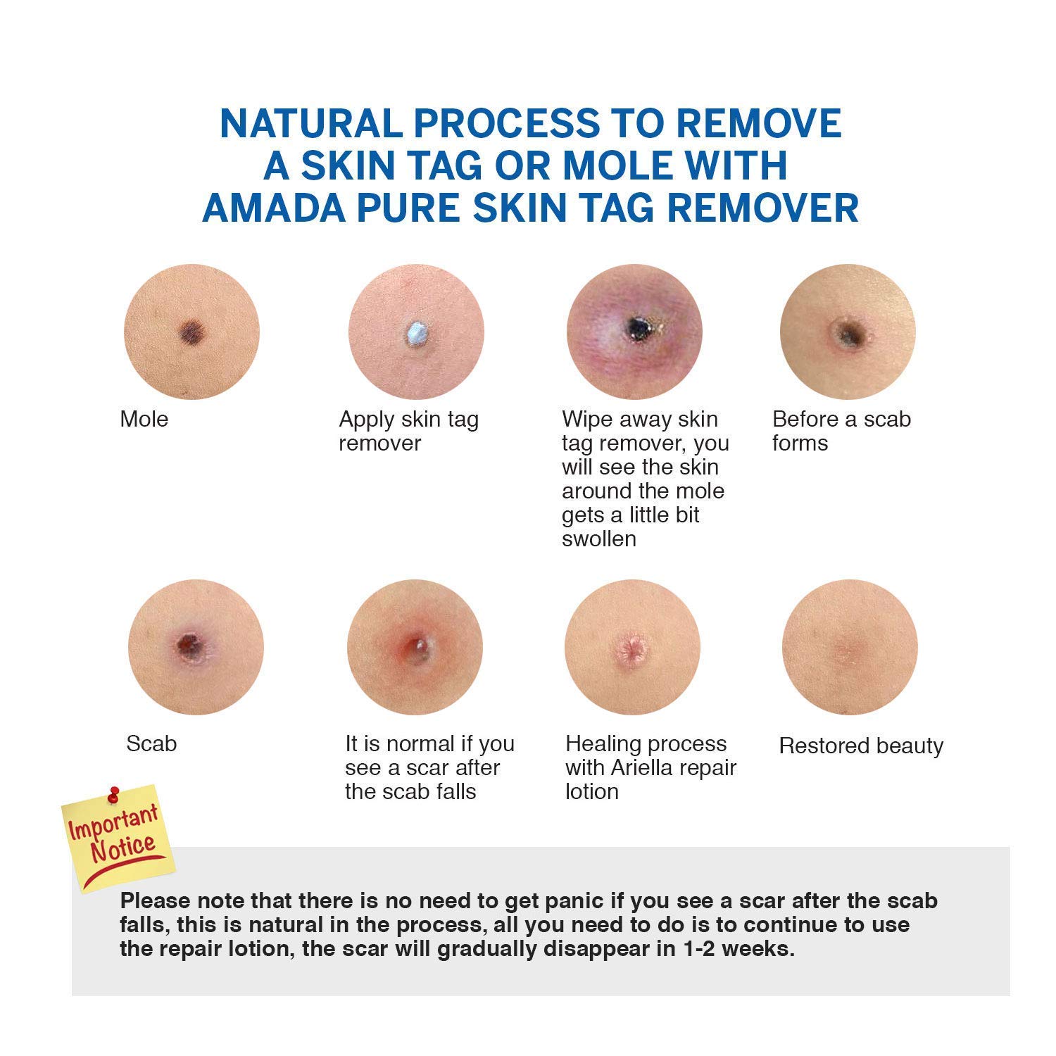 Amada Pure Mole Corrector & Skin Tag Remover and Repair Lotion Set, Remove Moles and Skin Tags Easy at Home Use : Beauty