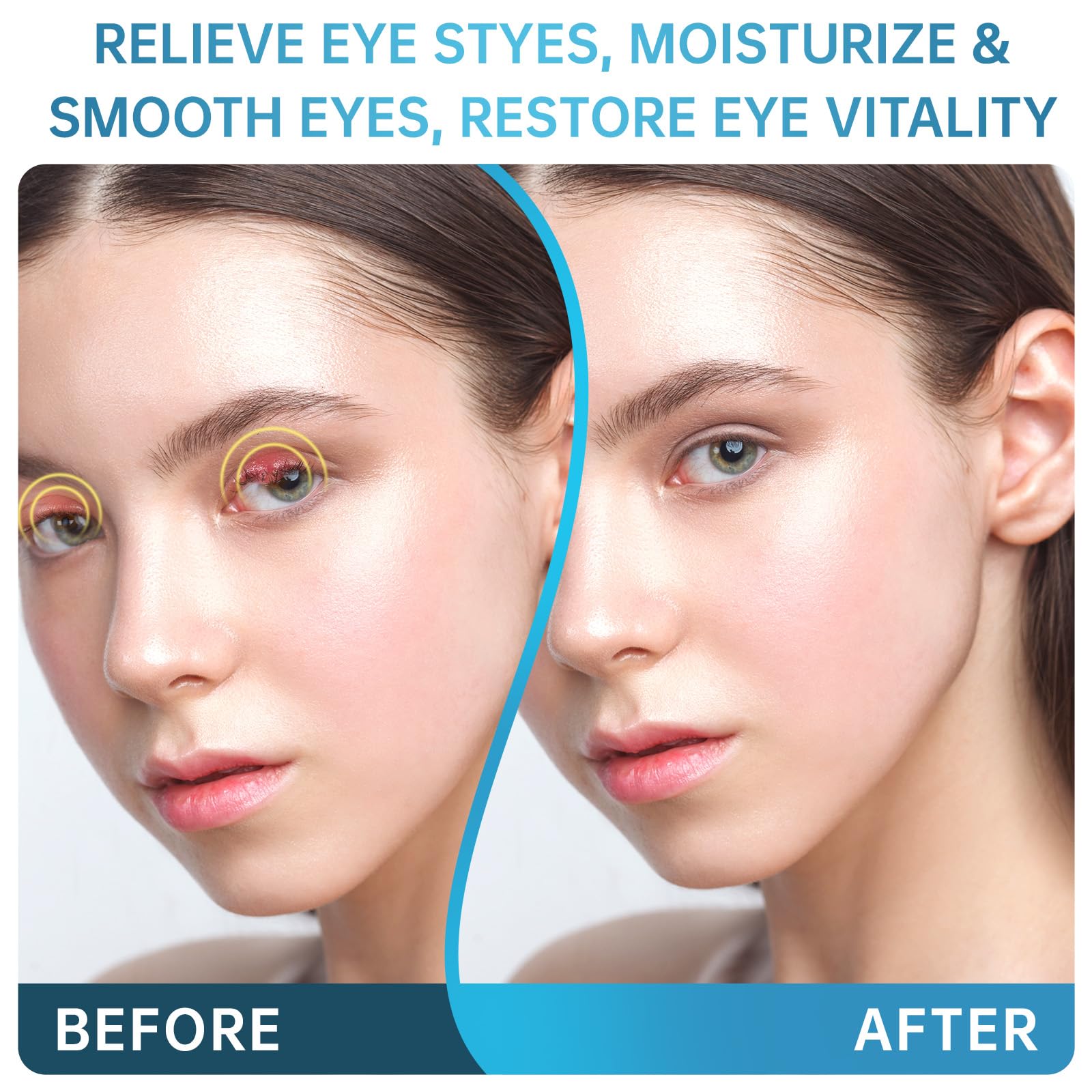 Eye Treatment Serum, Chalazion & Blepharitis Remover With Avocado Oil, Buckthorn Oil For Eyelid, 30ML Tea Tree & Caffeine Eye Serum For Redness, Puffiness, Eye Relief.