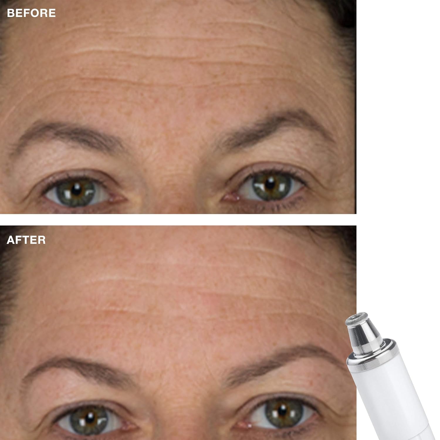 Trophy Skin Precision Diamond Tip - Trophy Skin Microdermabrasion: Beauty