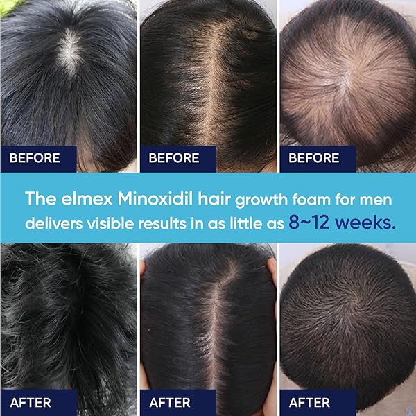 ARTIMORE 5% MINOXIDIL FOAM 1PCS, 5% MINOXIDIL FOR MEN FOAM, MINOXIDIL FOR WOMEN HAIR GROWTH, MINOXIDIL FOAM FOR WOMEN, MINOXIDIL FOAM FOR MEN HAIR., BLUE