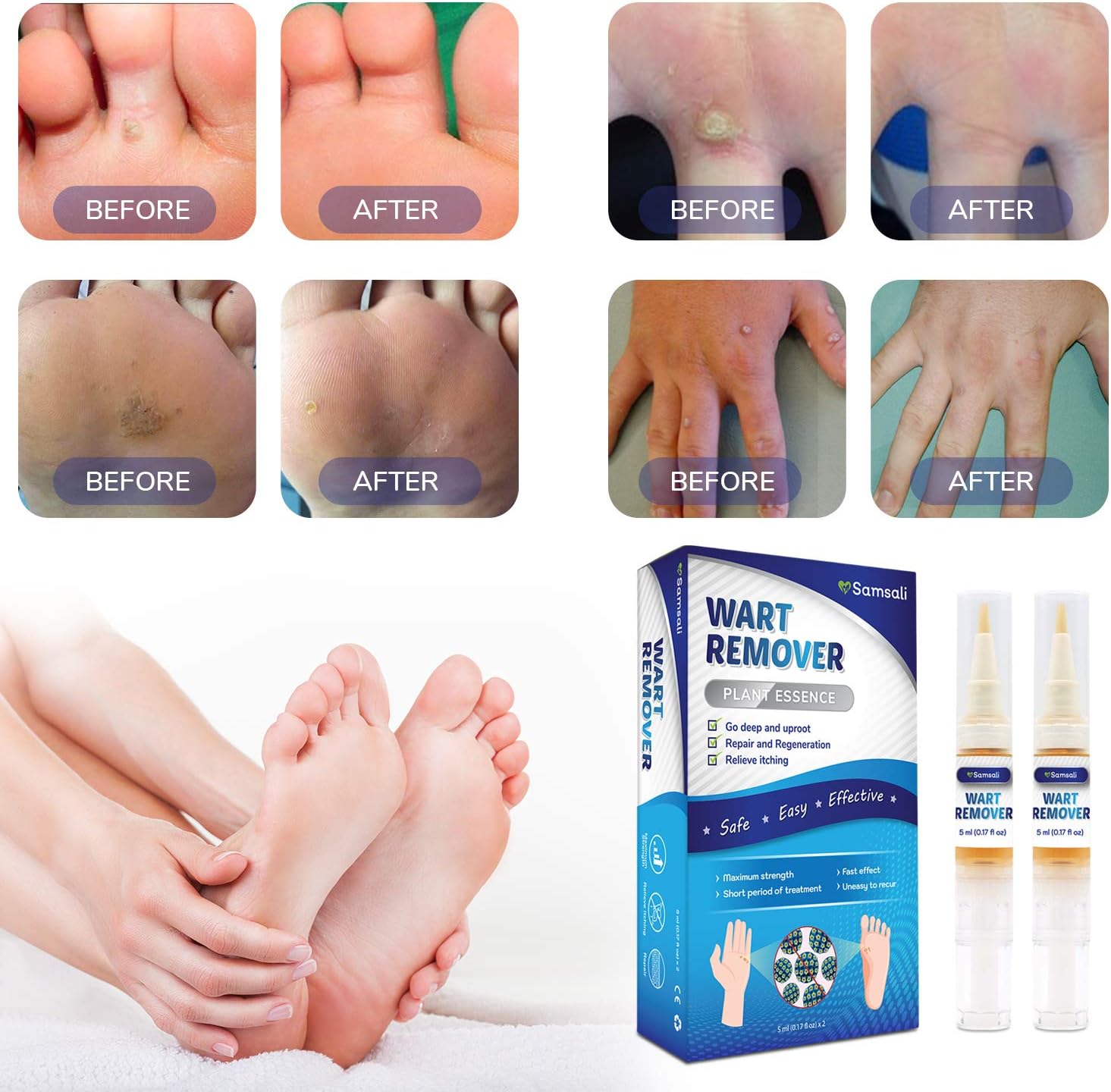 Samsali Wart Remover, Maximum Strength, Easy and Painless Wart Remover,  Removing all Kinds of Common Warts, Best Wart Remover for Removing Warts: Health & Personal Care