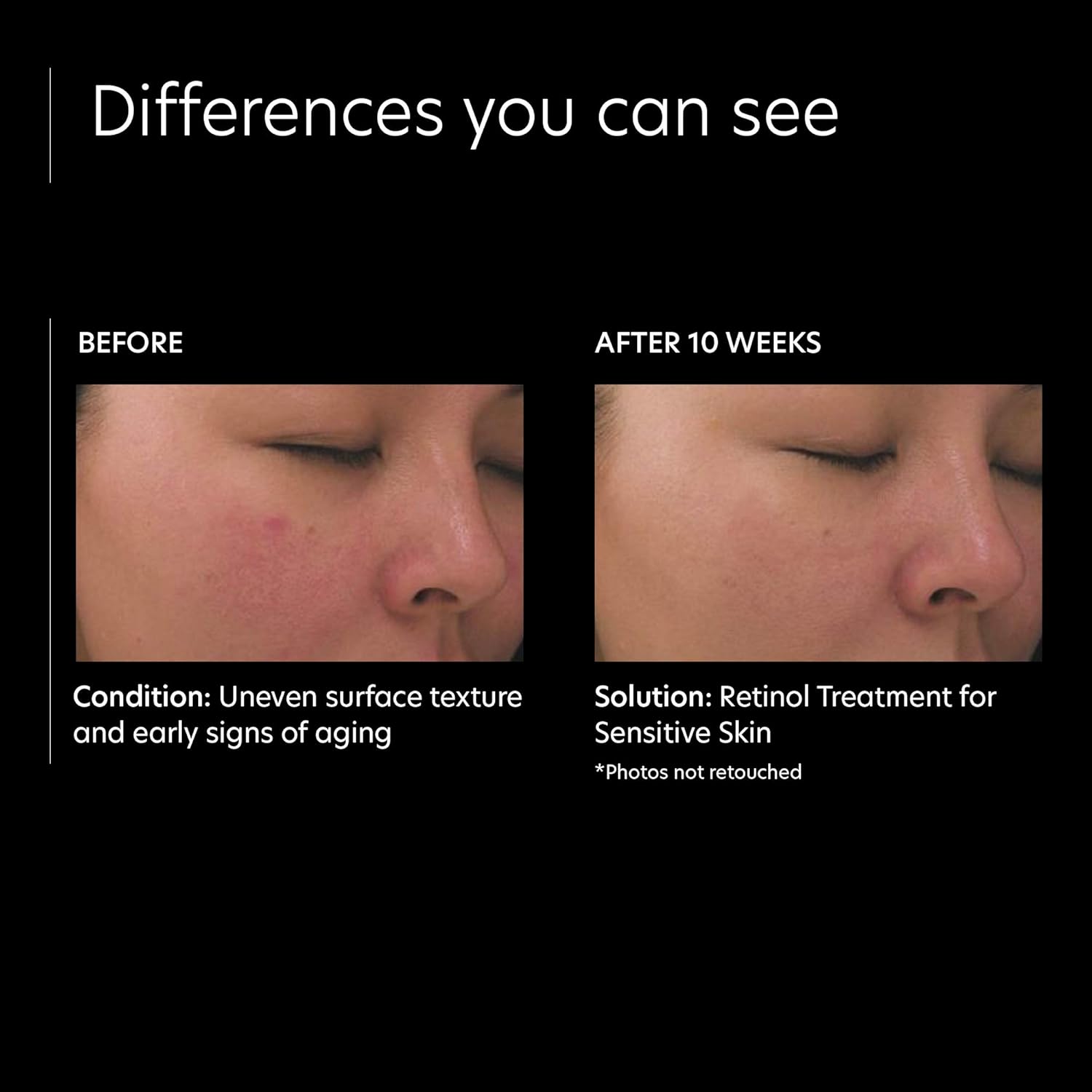 pca skin retinol treatment for sensitive skin