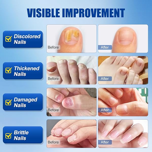 TOENAIL FUNGUS TREATMENT EXTRA STRENGTH 30ML, WUNILA MULTI-PURPOSE NAIL REPAIR SOLUTION FOR DISCOLORED DAMAGED NAILS, PLANT OIL FOR FUNGAL NAIL FUNGUS TREATMENT FAST ACTING, TOE NAIL FUNGUS TREATMENT