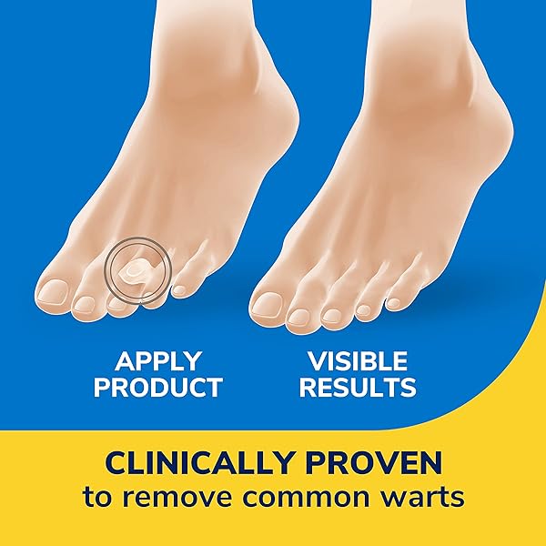 DR. SCHOLL’S CLEAR AWAY WART REMOVER HYDROGEL BANDAGES FOR FINGERS AND TOES – CLINICALLY PROVEN EFFECTIVE WART REMOVAL AND CUSHIONING PAIN RELIEF, COMFORTABLE MULTI-DAY COVERAGE PATCHES