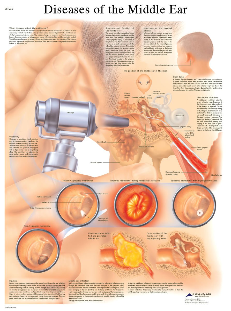3B Scientific Human Anatomy - Diseases of the Middle Ear Chart, Laminated Version