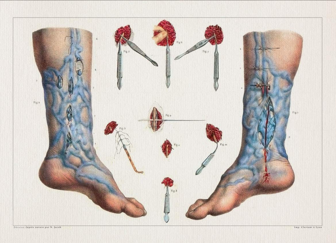 Amazon Com Anatomy Varicose Veins Foot Print Sra3 12x18 Conqueror Laid Paper Handmade