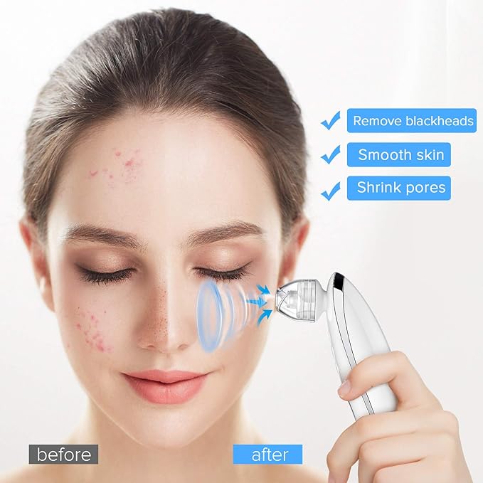 Odkurzacz do usuwania zaskórników, LANDWIND 2020 ulepszony ...