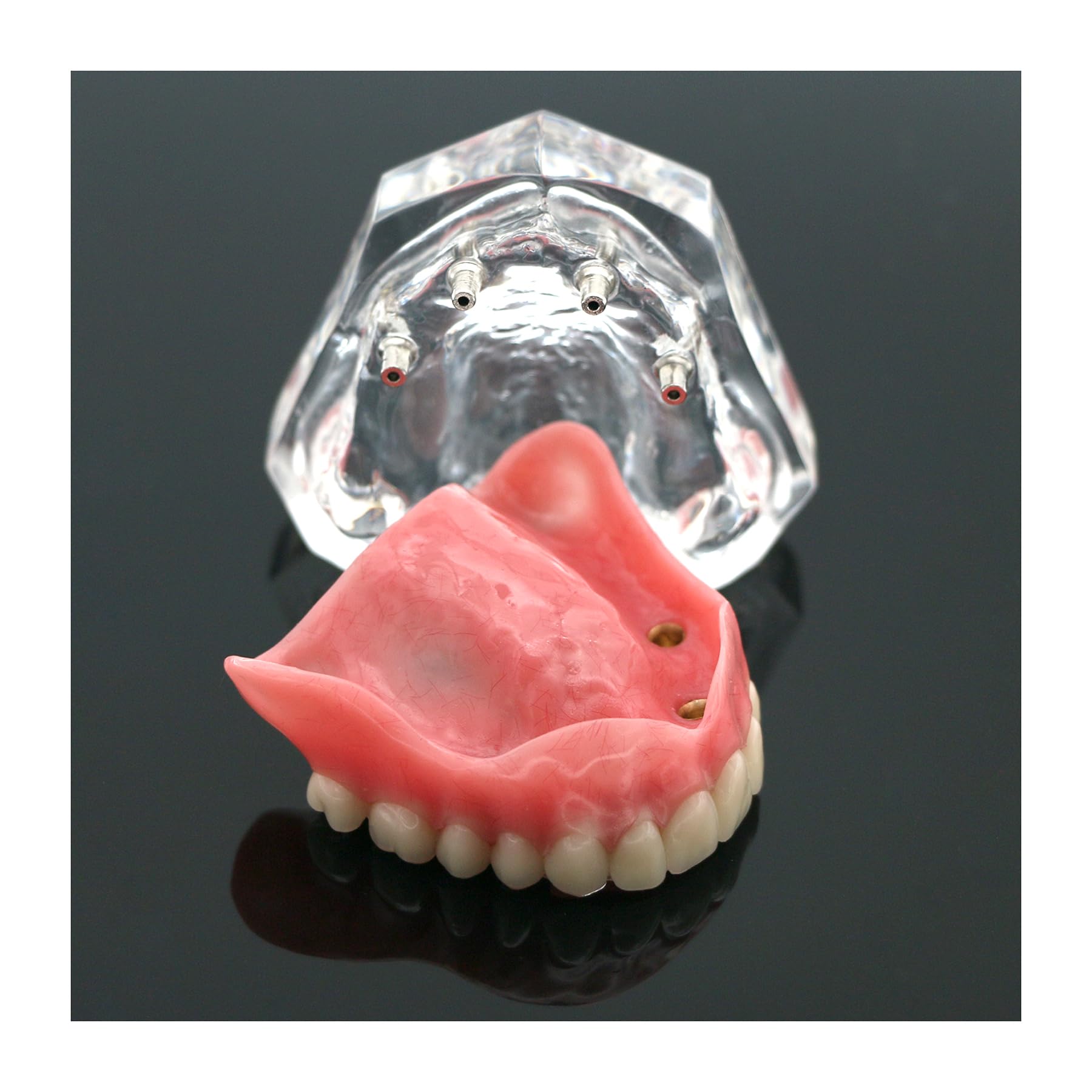Photo 1 of Dental Typodont Implant Teeth Model Clear Overdenture 4 Implants Maxillary Superior Upper Restoration Demo M6001 Clear Base for Studying Teaching