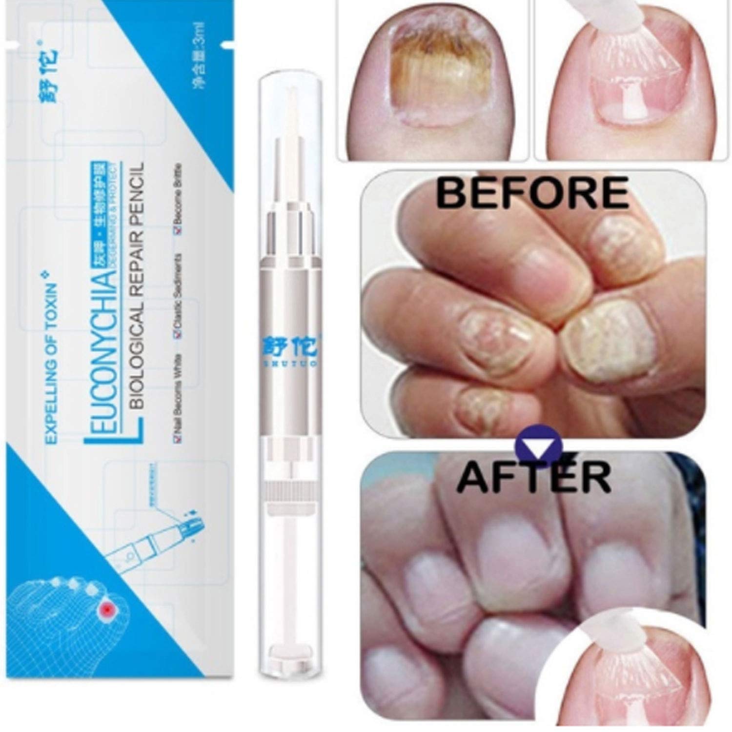 Fungal Nail Infection Treatment amazon com foreverharbor 3ml fungal nail treatment pen onychomycosis paronychia anti fungal nail infection chinese herbal toe nail fungus treatment home