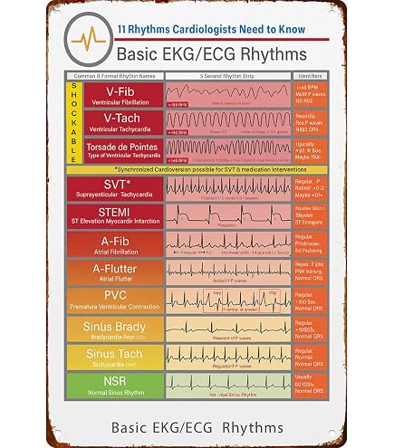Common Heart Rythmns 10 Most Common Ecg Rhythms
