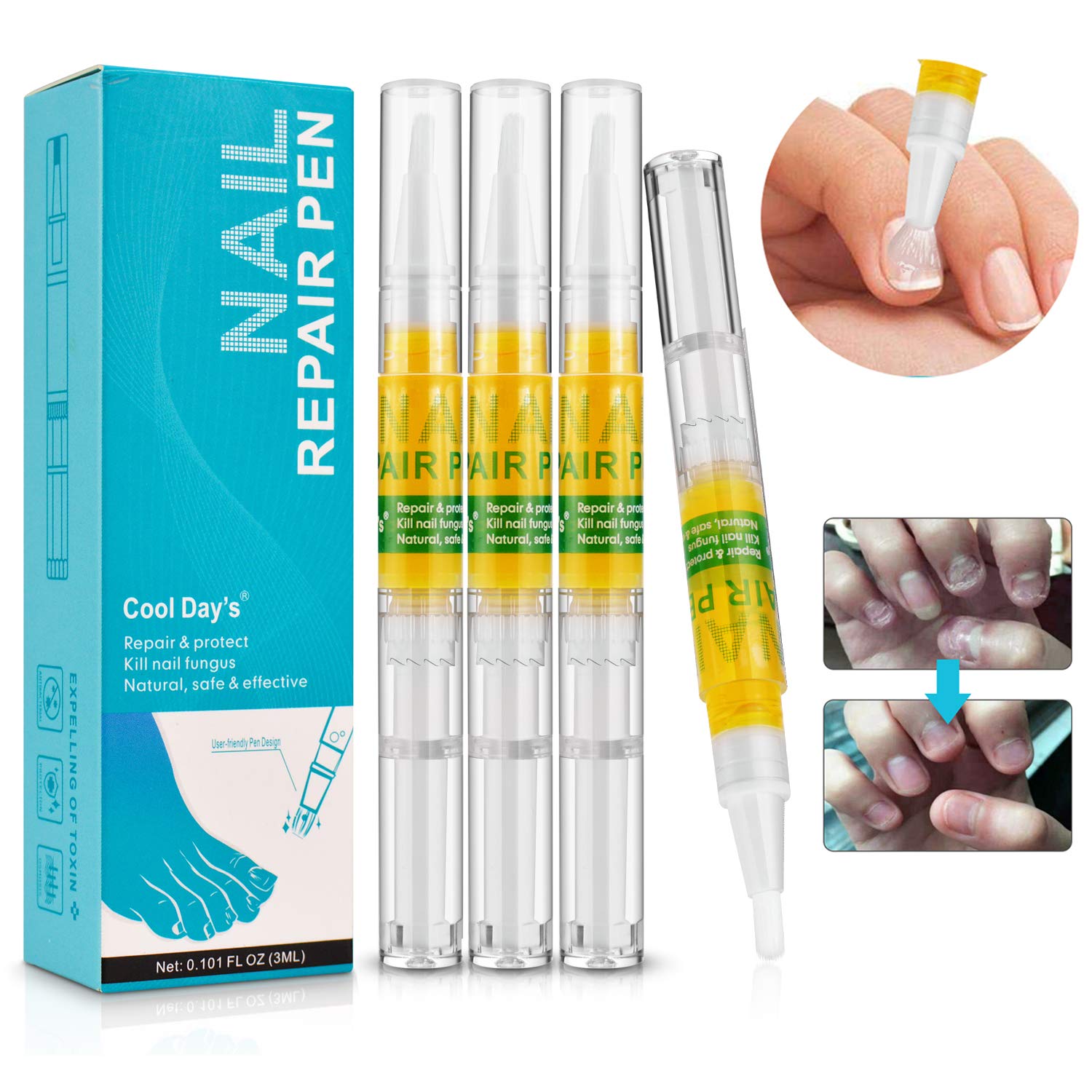 Nail Repair Pen, 4 Nail Fungus Treatment Pens Toenail and Nail Care Solution, Fingernails and Repairs Damaged Brittle Nails, Onychomycosis Removal Essence Foot Care, Fixes and Restore Discolored