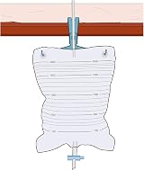 E&E Catheter Bag Hanger - 2L Urine Drainage Bag Stand - Secure & Sturdy view 4