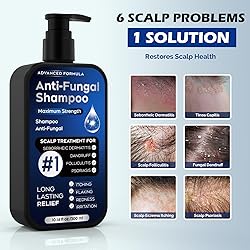 Antifungal Shampoo for Seborrheic