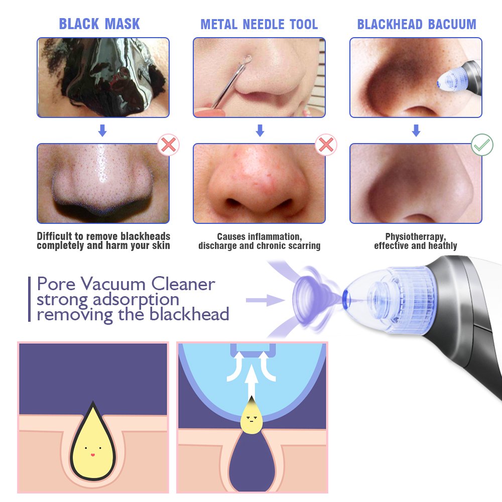 Mckbane Electric Blackhead Remover (Newest Version) Portable Facial Pore Acne Comedo Cleanser Blackhead Suction Device Skin Care Tool Set of White with 4 Heads USB Rechargeable for Women Men (White)