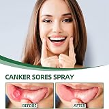 HIVETZ Mouth Ulcer Treatment Spray Herbal Breath Freshener Adults view 7