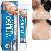 Vitiligo Cream, Natural Vitiligo Treatment for Skin Vitiligo, Reduce White Spots and Improve Skin Pigmentation, Easy to Use, Vitiligo Care Cream, 20g
