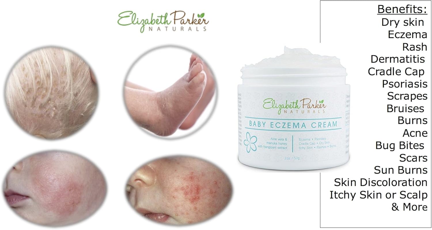 aloe vera cream for baby eczema