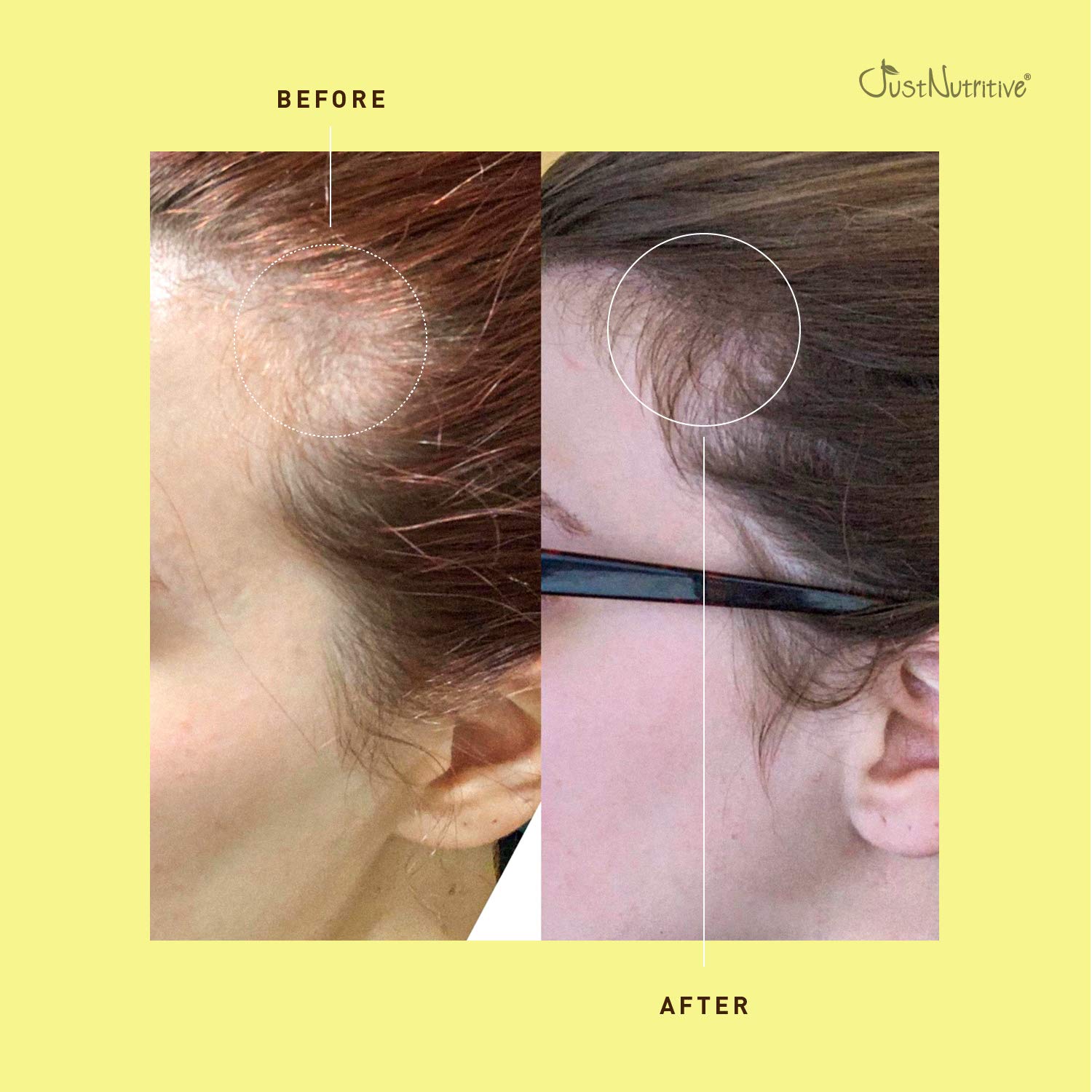 Bald Spot Treatment | Scalp Spot Cream : Hair Regrowth Treatments : Beauty
