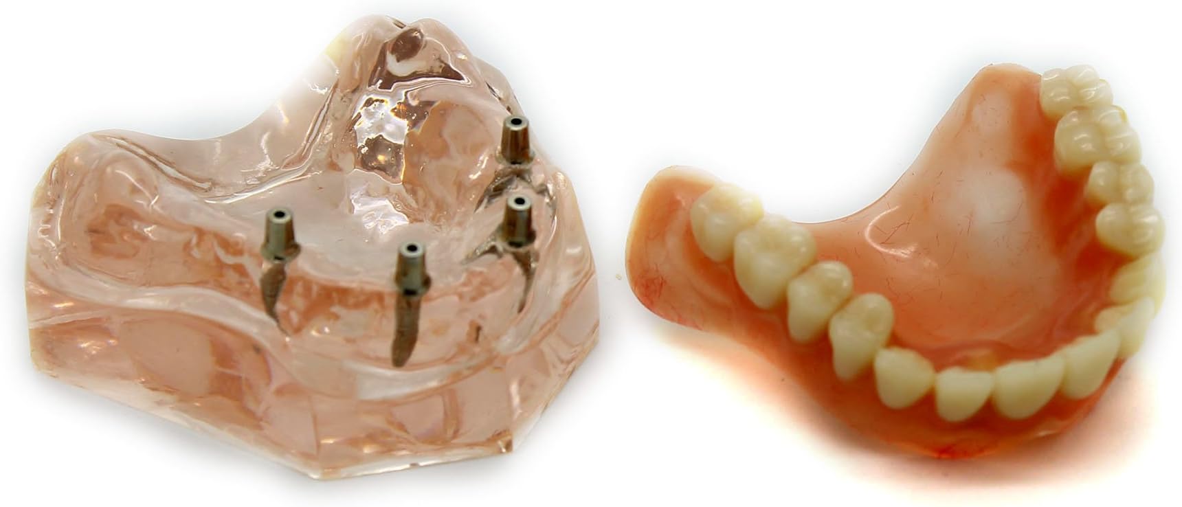 Lanjing Dental Model #6001 01 - Overdenture Superior with 4 Implants Demo Model