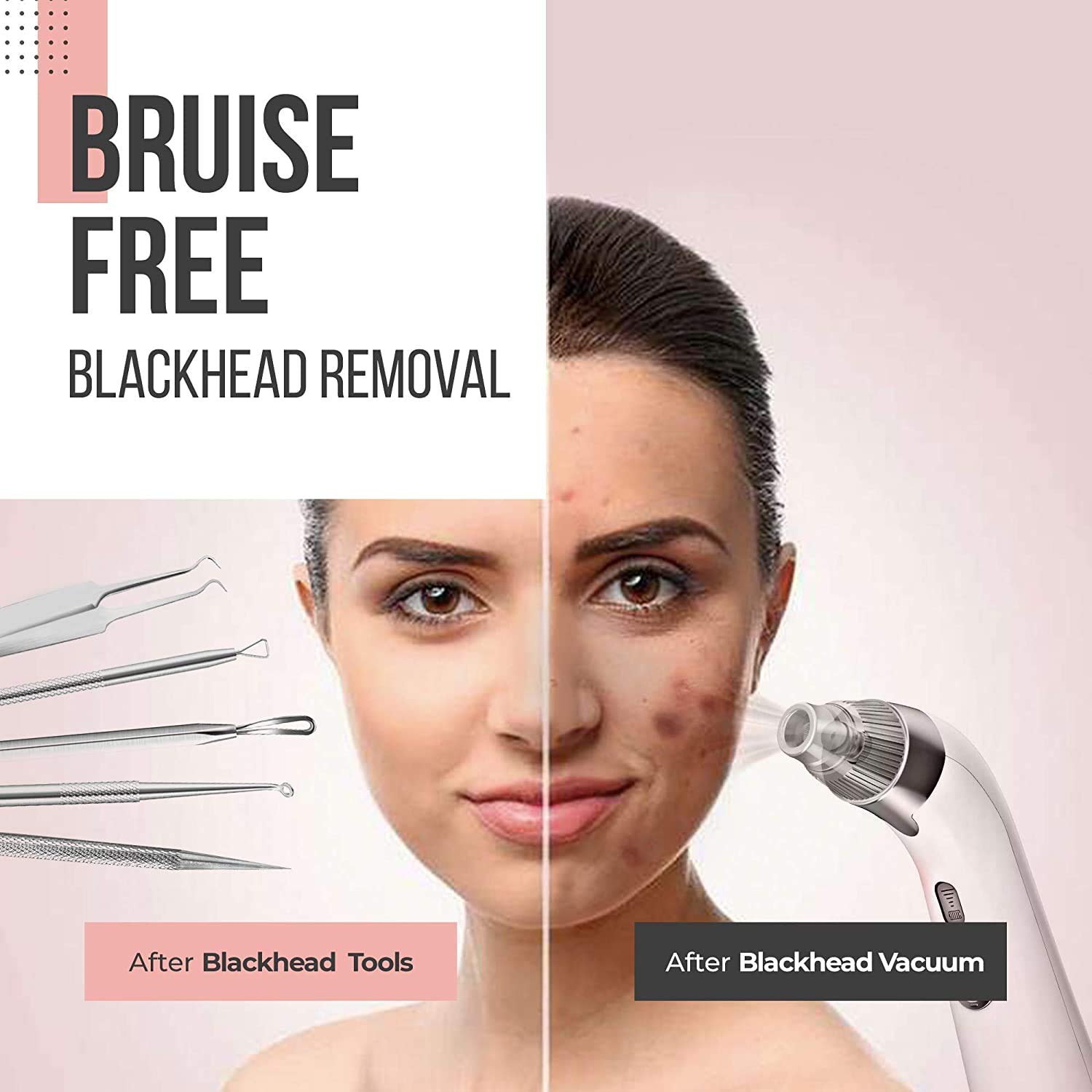 Professional Pimple Popper Tool Kit - With Comedone Extractor, Milia Removal Tool, Blackhead Tweezers, and Whitehead Remover Tool, Spot Treatment Acne Set, by The Good Stuff: Beauty