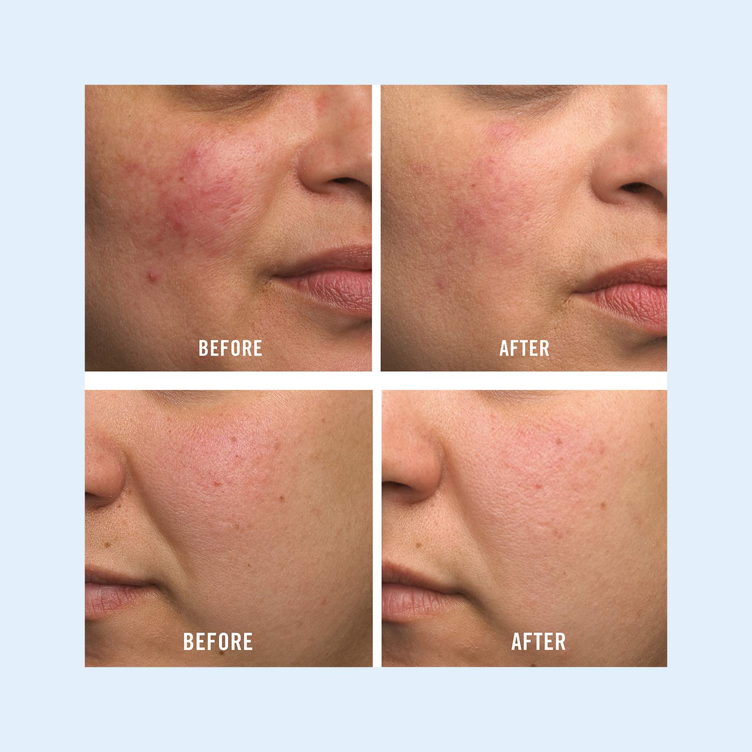 First Aid Beauty Ultra Repair Cream Intense Hydration Moisturizer for Face and Body - 6 oz. : Body Skin Care Products : Beauty