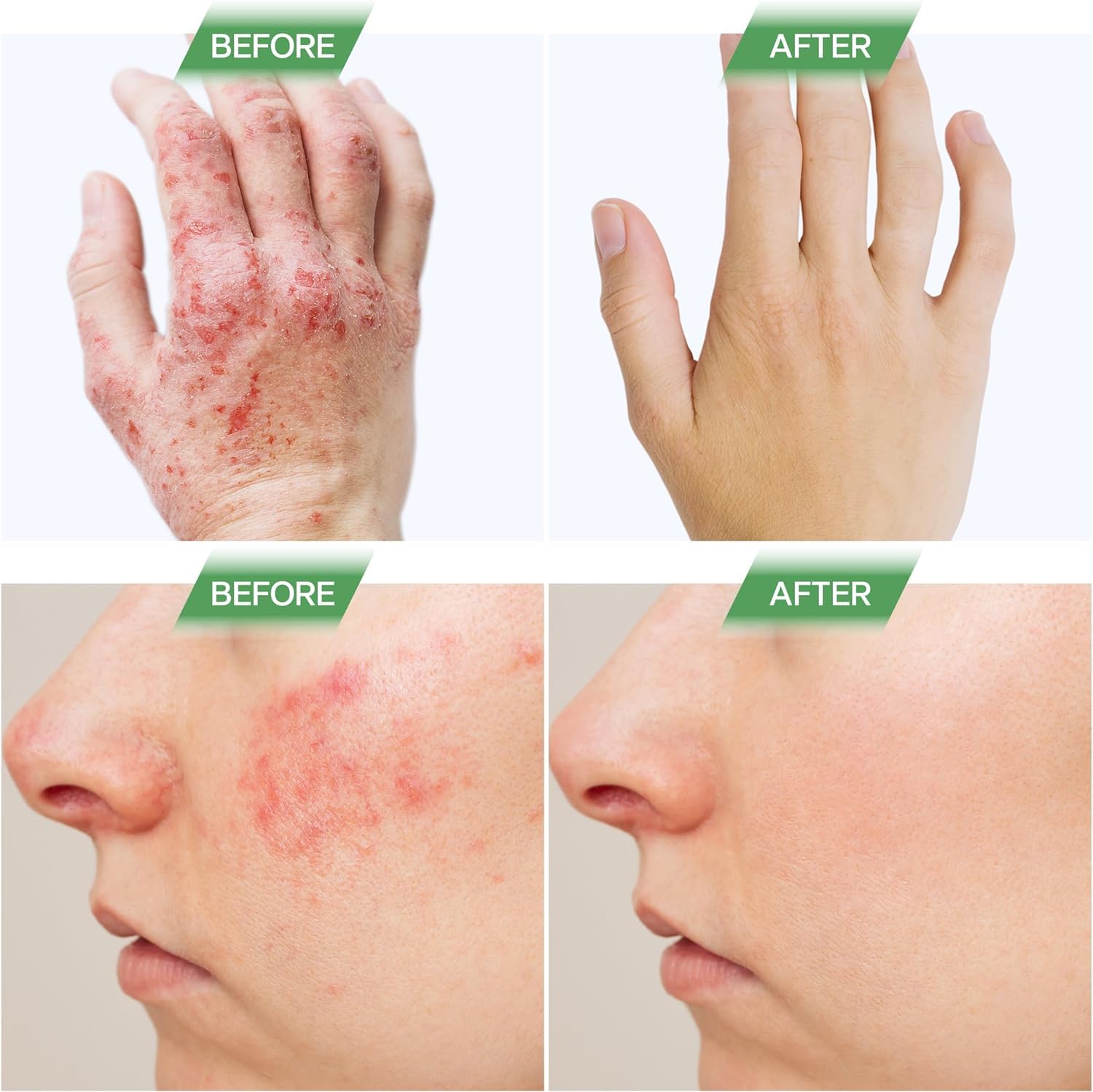 Naturevite Sugar-Free Eczema Treatment Gummies — USA-Made, 10x Effective, 20+ Vitamins Support Eczema Treat, Psoriasis, Rosacea & Dermatitis — Healthy Skin, Soothes Itching & Redness (60 Gummies)