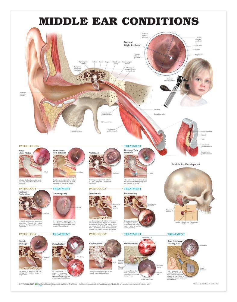 Middle Ear Conditions Anatomical Chart