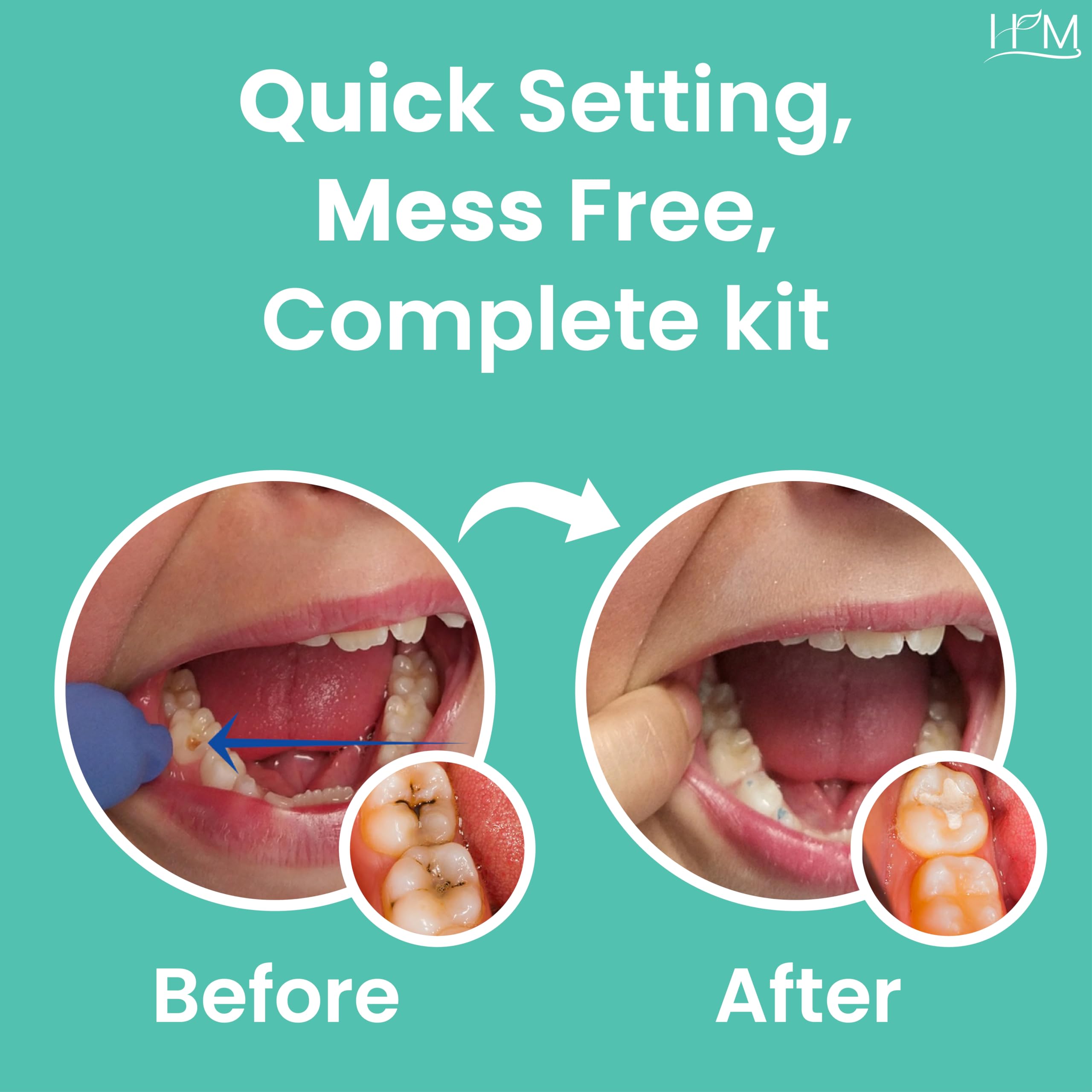 HM Zinc Oxide Eugenol Dental Cement Kit | Super Adhesive | Instant Tooth Repair, Cap, Crown & Bridge Filling | DIY, Self Curing, Sturdy & High Strength |Universal Shade| Emergency Dental Care | 1 Box