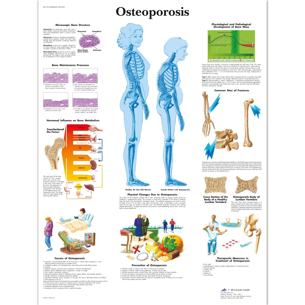 3B Scientific Human Anatomy - Osteoporosis Chart, Laminated Version