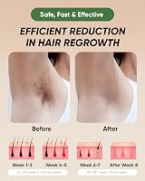 XSOUL IPL Hair Removal Device 999,999 Flashes Painless for Men & Women view 5